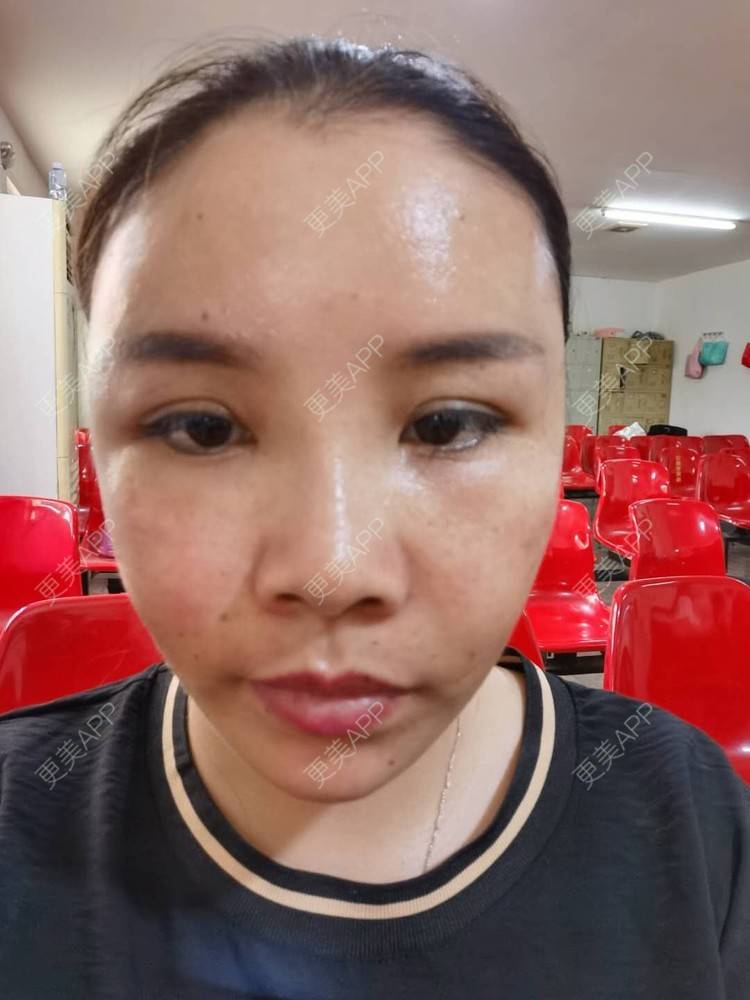 更美 - 更美用户zvR6Y28g4s的自体脂肪全面部填充经验 | 自体脂肪全面部填充 | 自体脂肪面部填充
