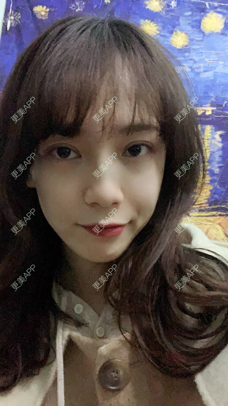 更美 - 更美用户CKvakkeJkI的自体脂肪面部填充经验 | 自体脂肪面部填充 | 郑州