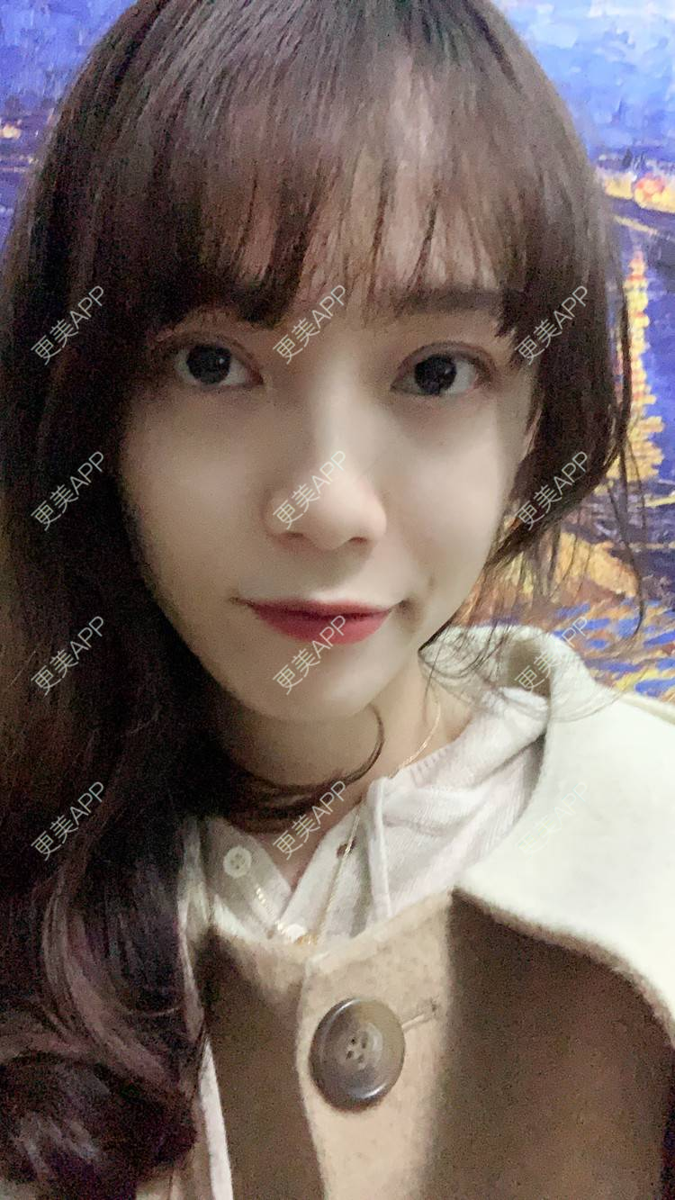 更美 - 更美用户CKvakkeJkI的自体脂肪面部填充经验 | 自体脂肪面部填充 | 郑州