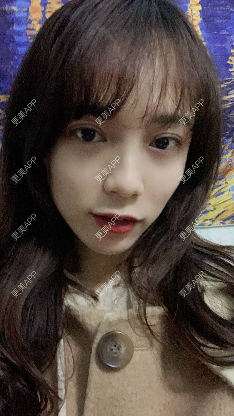 更美 - 更美用户CKvakkeJkI的自体脂肪面部填充经验 | 自体脂肪面部填充 | 郑州