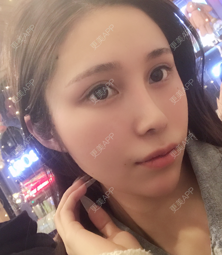 更美 - 更美用户EmhD0DiqON的M唇成形经验 | M唇成形