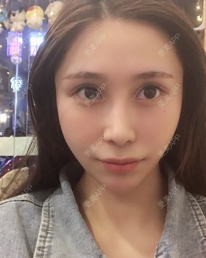 更美 - 更美用户EmhD0DiqON的M唇成形经验 | M唇成形