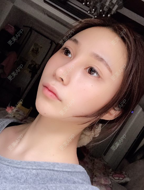 更美 - 更美用户EmhD0DiqON的M唇成形经验 | M唇成形