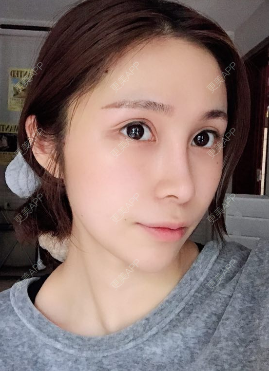更美 - 更美用户EmhD0DiqON的M唇成形经验 | M唇成形