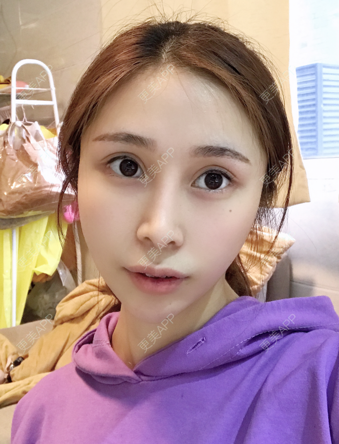 更美 - 更美用户EmhD0DiqON的M唇成形经验 | M唇成形