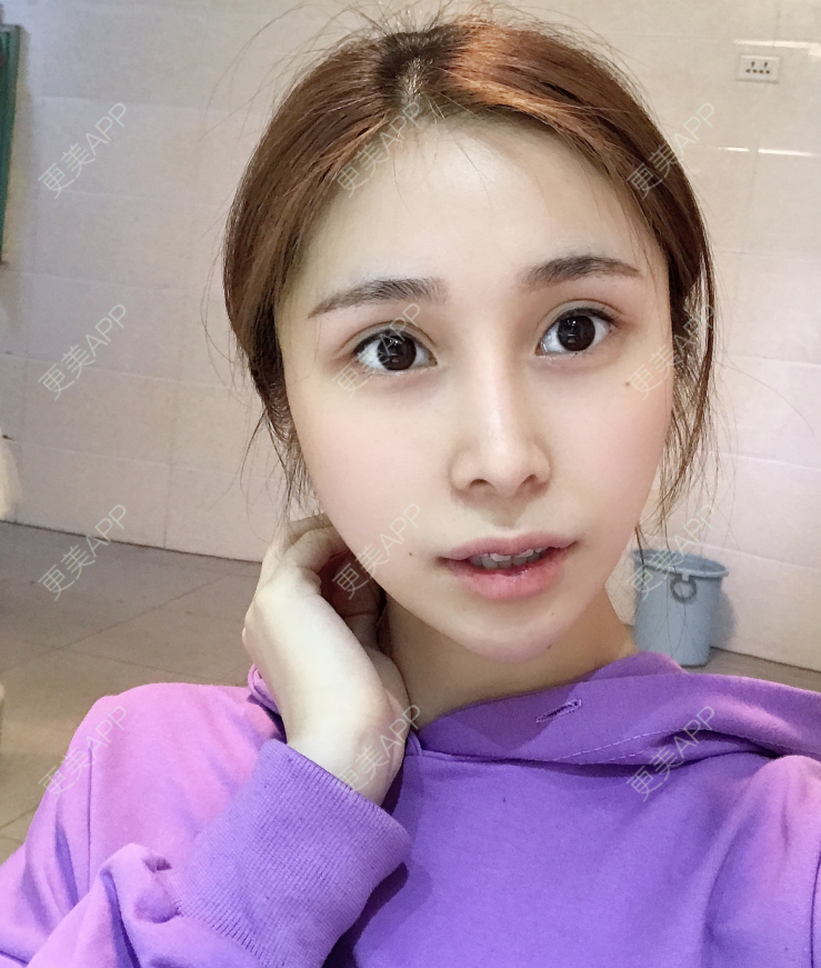 更美 - 更美用户EmhD0DiqON的M唇成形经验 | M唇成形