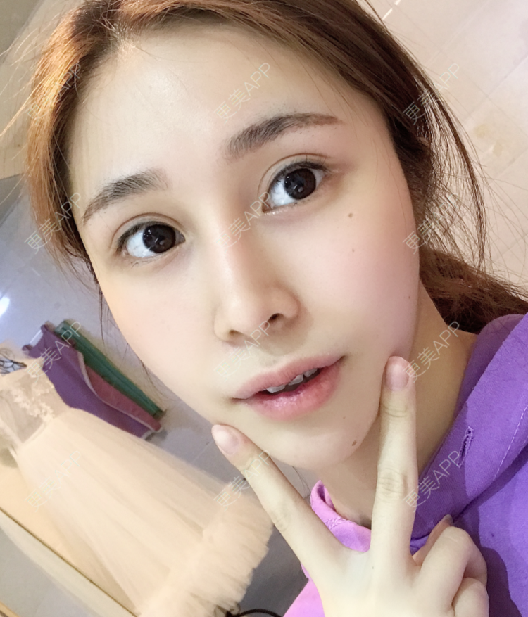 更美 - 更美用户EmhD0DiqON的M唇成形经验 | M唇成形