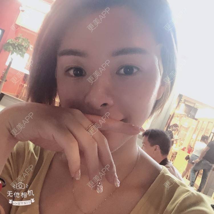 更美 - 更美用户yPMgeL4UoH的埋线除皱经验 | 埋线除皱