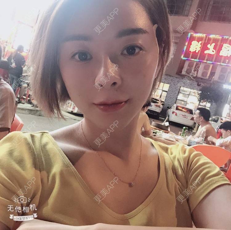 更美 - 更美用户yPMgeL4UoH的埋线除皱经验 | 埋线除皱