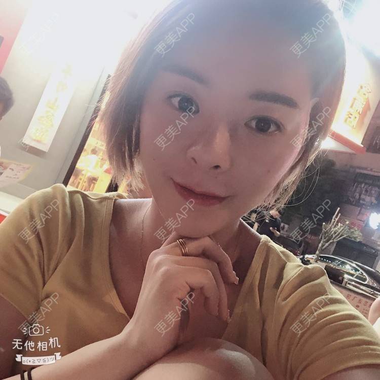 更美 - 更美用户yPMgeL4UoH的埋线除皱经验 | 埋线除皱