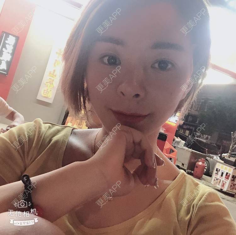 更美 - 更美用户yPMgeL4UoH的埋线除皱经验 | 埋线除皱