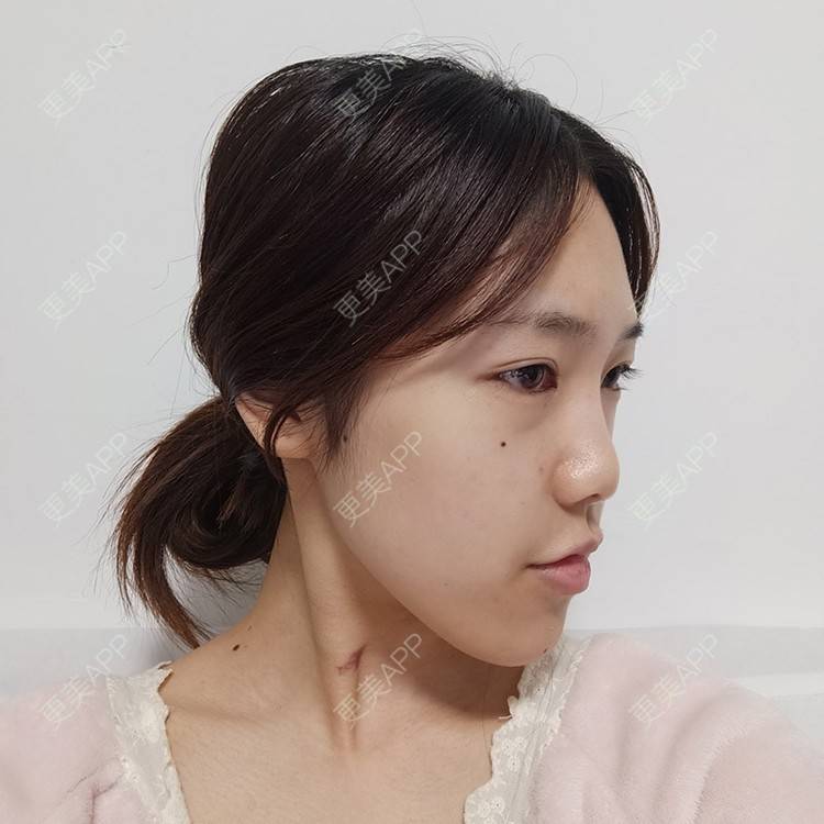 更美 - 别放香菜啊 老板的膨体隆鼻经验 | 鼻部多项 | 膨体隆鼻 | 青岛