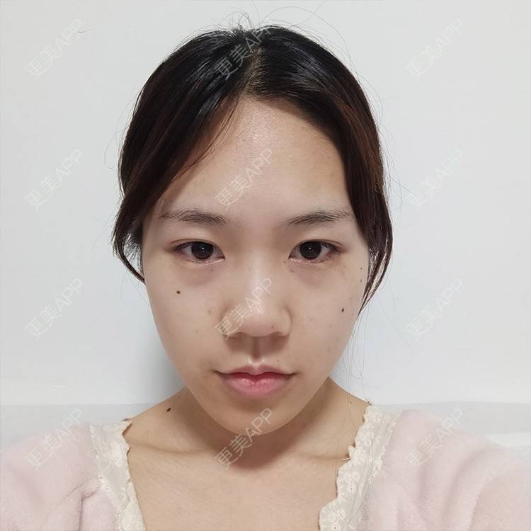 更美 - 别放香菜啊 老板的膨体隆鼻经验 | 鼻部多项 | 膨体隆鼻 | 青岛