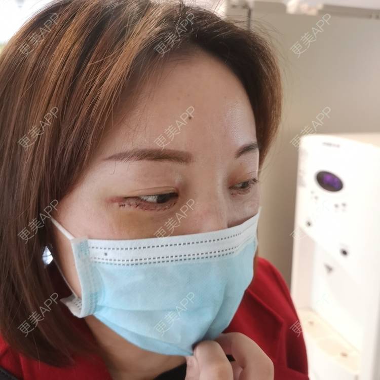 更美 - 更美用户8Z3nsQztj2的综合去眼袋经验 | 外切去眼袋 | 综合去眼袋 | 深圳