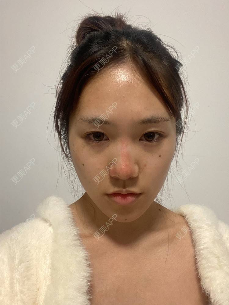 更美 - 别放香菜啊 老板的膨体隆鼻经验 | 鼻部多项 | 膨体隆鼻 | 青岛