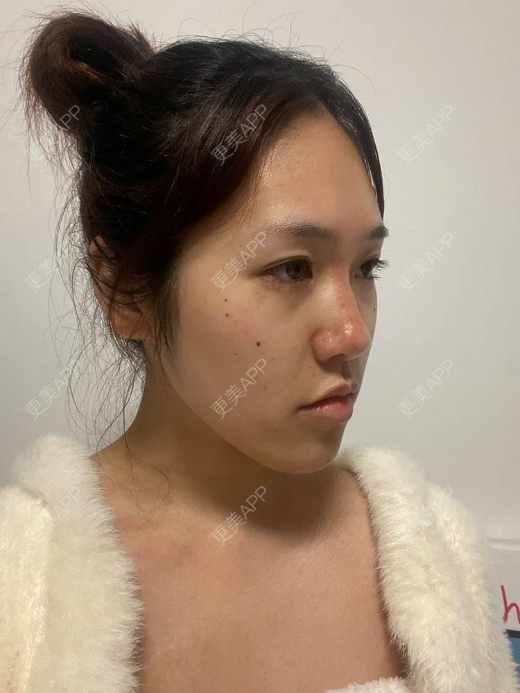 更美 - 别放香菜啊 老板的膨体隆鼻经验 | 鼻部多项 | 膨体隆鼻 | 青岛