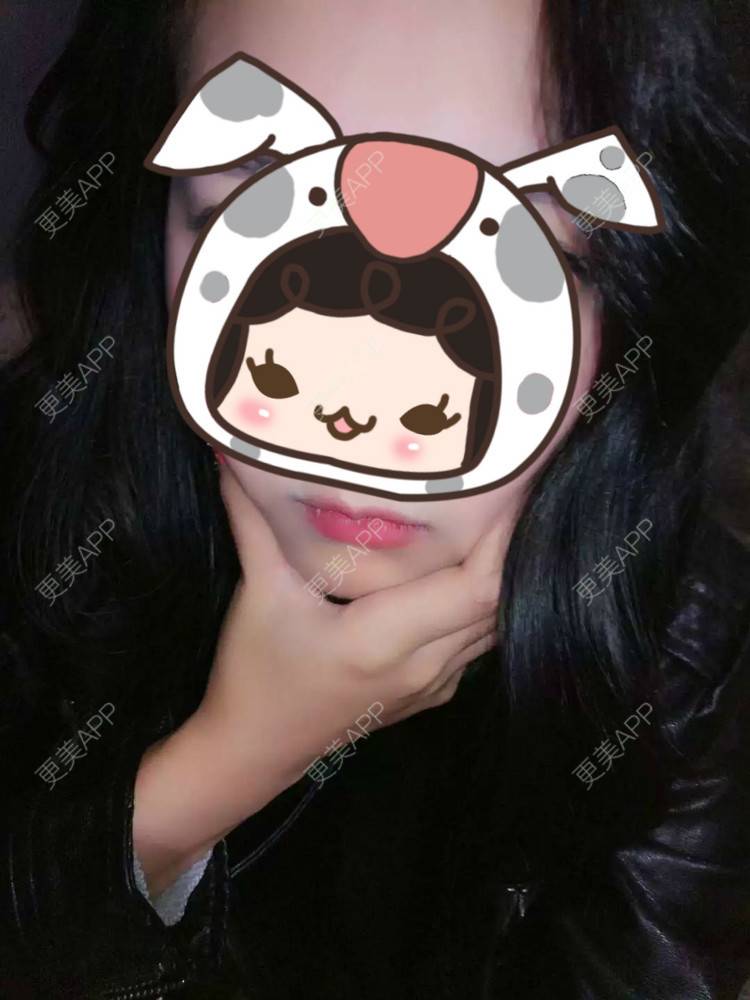 更美 - 眼泪画の婚礼桥的阴唇整形经验 | 上海 | 阴唇整形