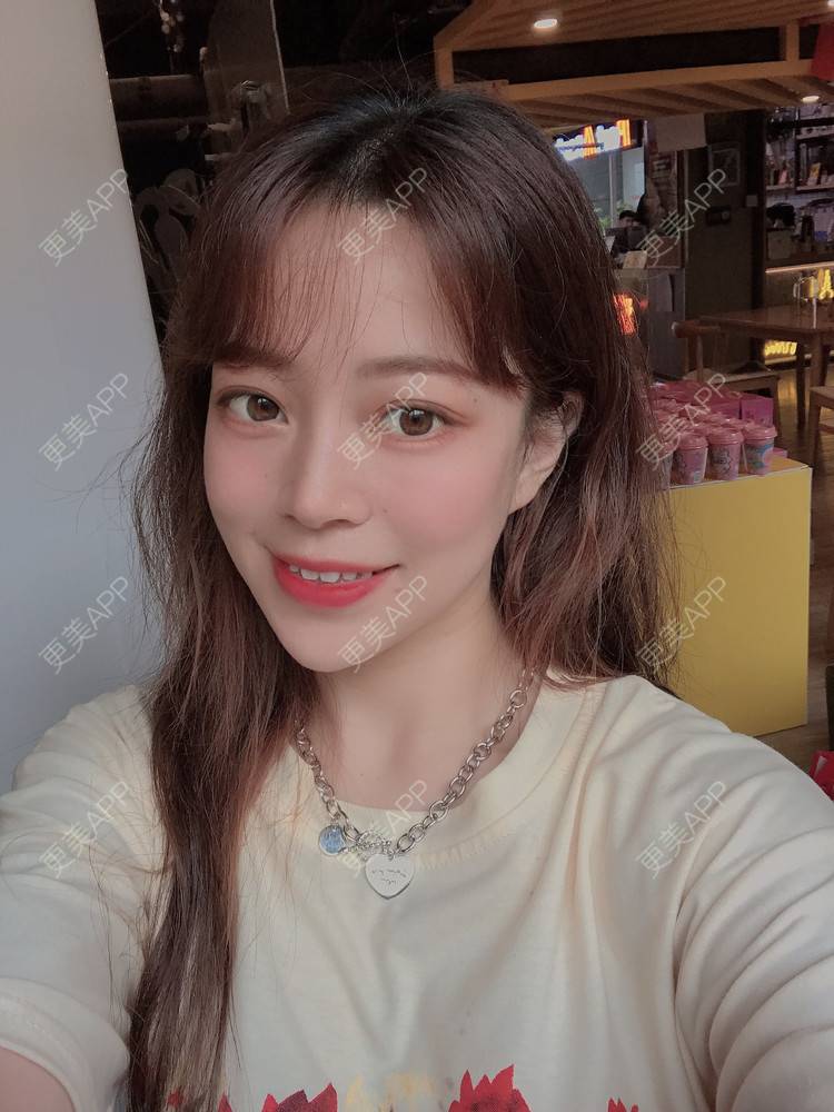 更美 - 悲催的风里椎的自体脂肪全面部填充经验 | 自体脂肪全面部填充 | 天津 | 视频日记
