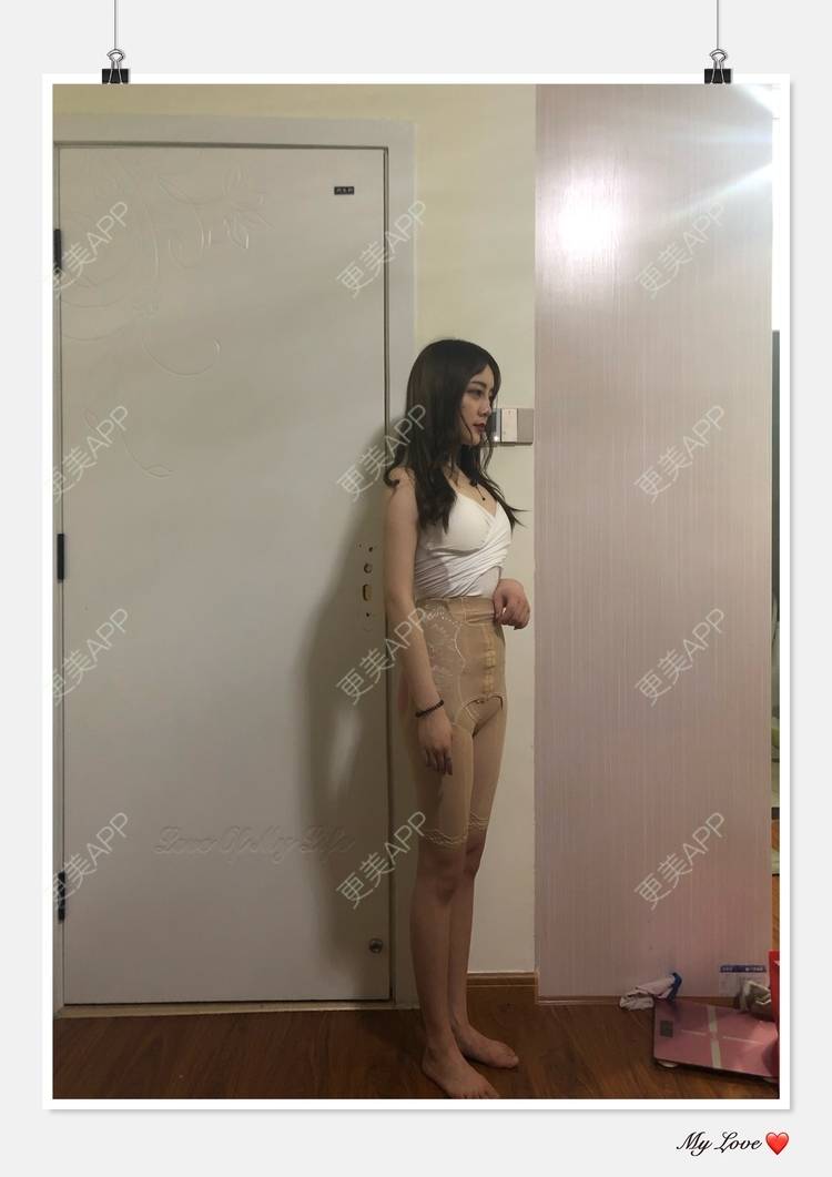 更美 - 更美用户R8khaDFdEz的吸脂瘦大腿经验 | 吸脂瘦大腿 | 深圳