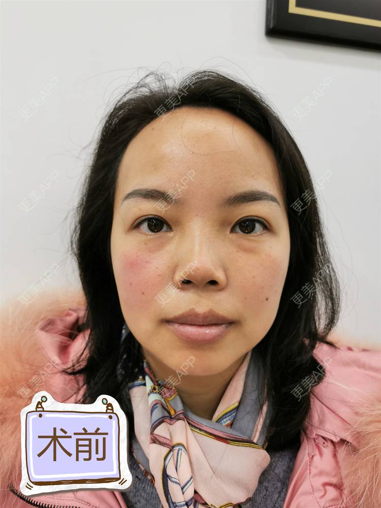 更美 - 萤火茶的内切去眼袋经验 | 内切去眼袋 | 重庆