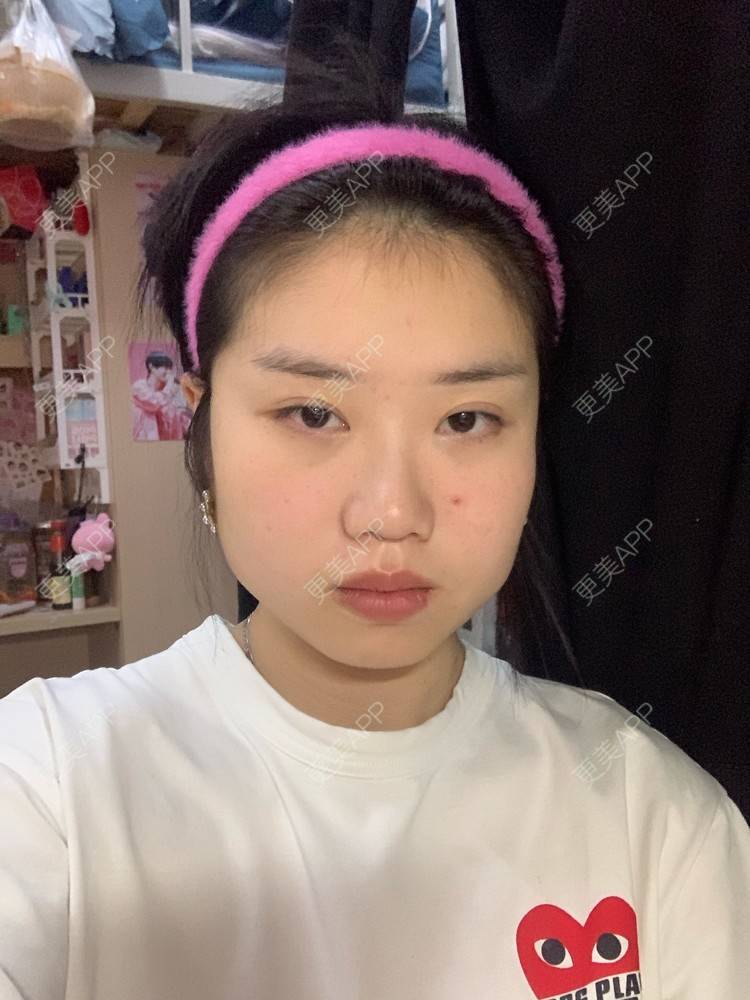 更美 - 月庭的下颌角切除经验 | 下颌角切除 | 下颌角整形 | 武汉