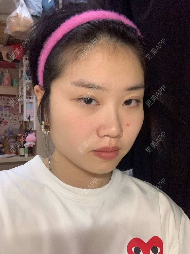更美 - 月庭的下颌角切除经验 | 下颌角切除 | 下颌角整形 | 武汉