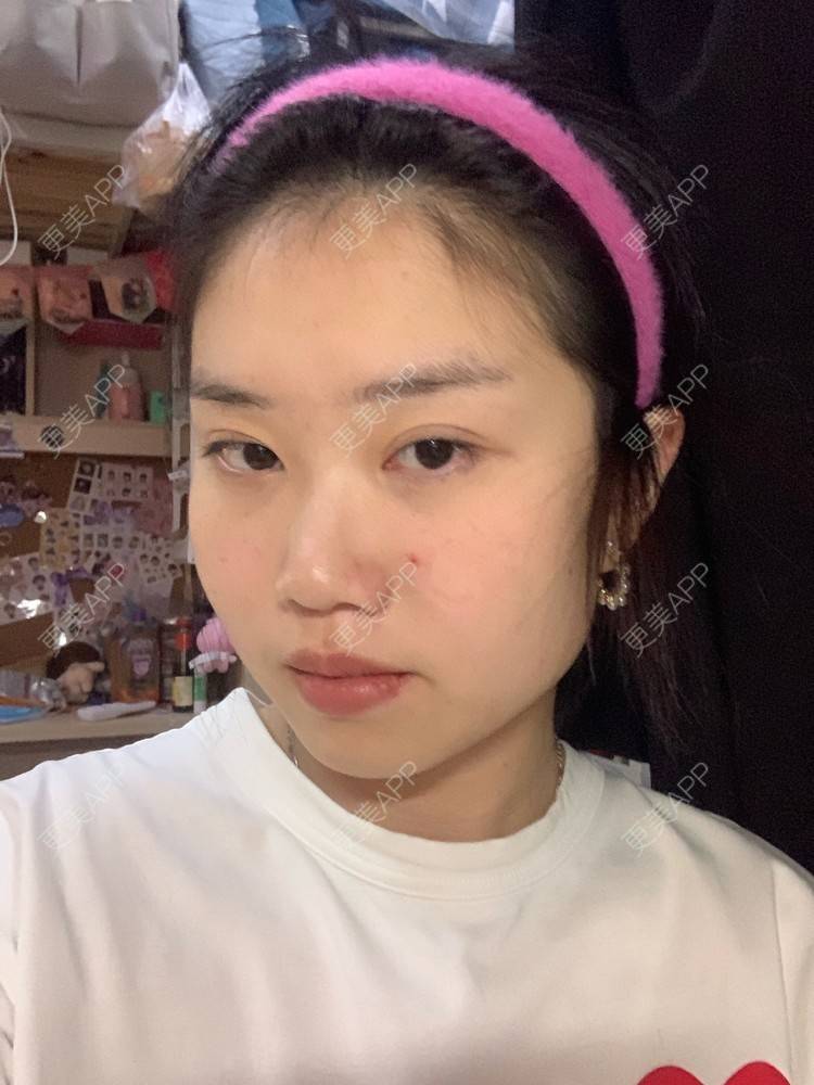 更美 - 月庭的下颌角切除经验 | 下颌角切除 | 下颌角整形 | 武汉
