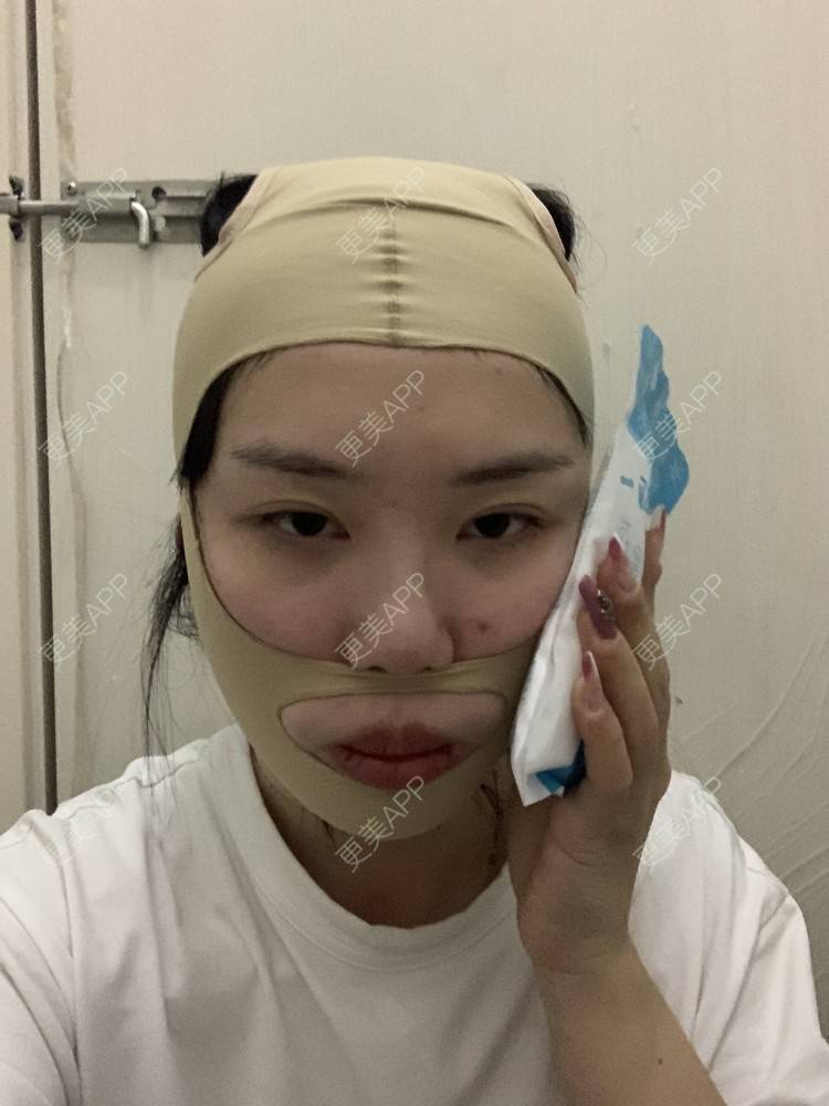 更美 - 月庭的下颌角切除经验 | 下颌角切除 | 下颌角整形 | 武汉
