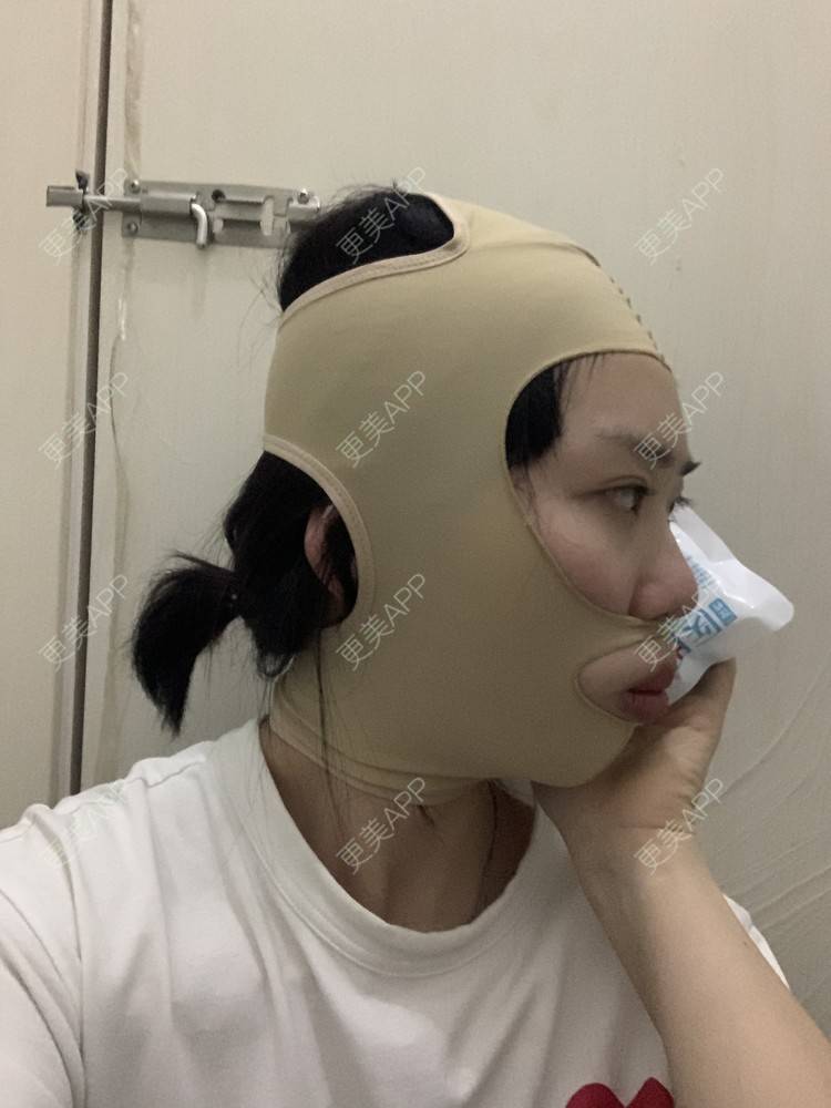 更美 - 月庭的下颌角切除经验 | 下颌角切除 | 下颌角整形 | 武汉