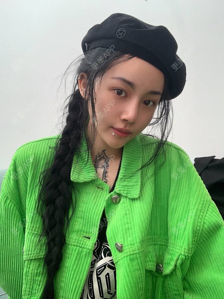 更美 - 咸甜小奶酪的硅胶垫下巴经验 | 硅胶垫下巴 | 肋软骨隆鼻 | 重庆 | 鼻形态修复