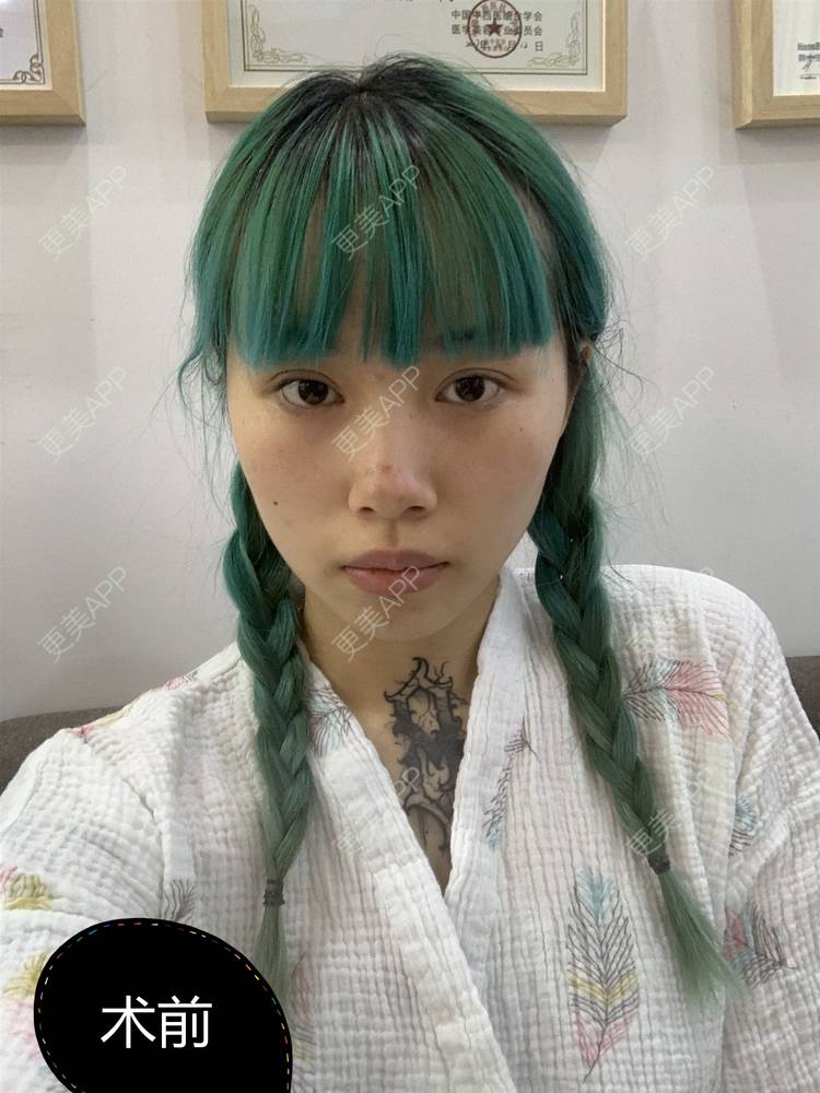 更美 - 咸甜小奶酪的肋软骨隆鼻经验 | 肋软骨隆鼻 | 重庆 | 鼻形态修复