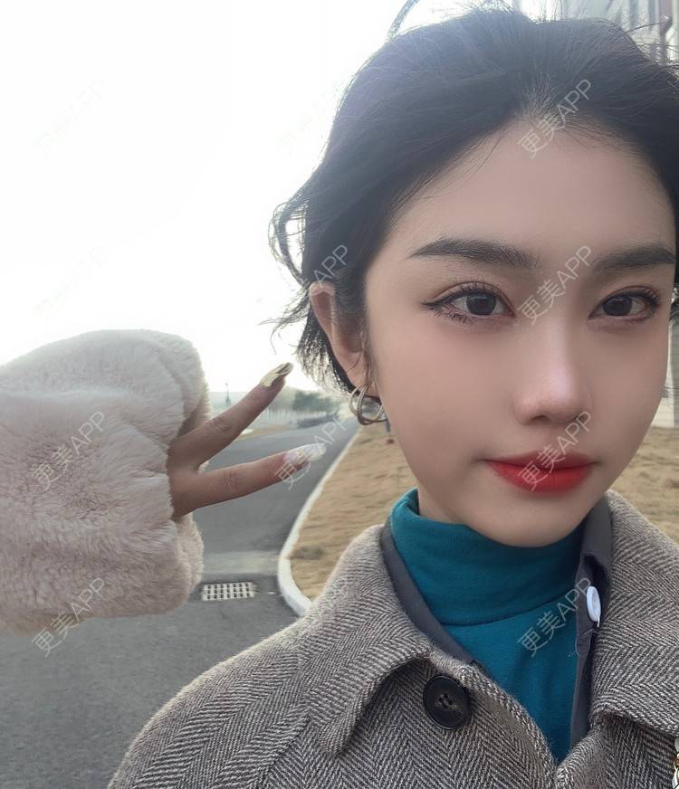 更美 - 月庭的下颌角切除经验 | 下颌角切除 | 下颌角整形 | 武汉