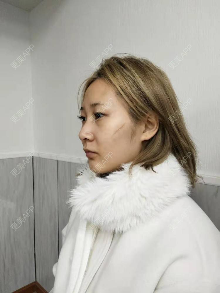 更美 - ﹏゛提拉米苏式乙的激光淡疤经验 | 皮肤综合管理套餐 | 祛疤痕痘印 | 激光淡疤 | 成都