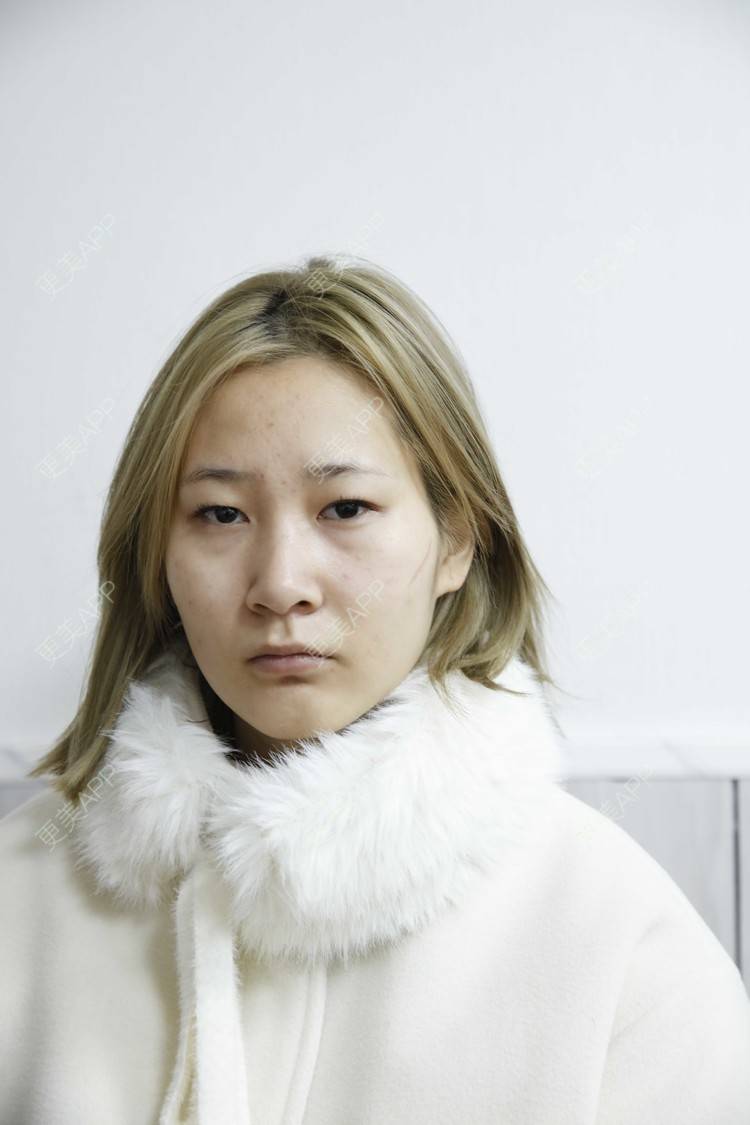更美 - ﹏゛提拉米苏式乙的激光淡疤经验 | 皮肤综合管理套餐 | 祛疤痕痘印 | 激光淡疤 | 成都