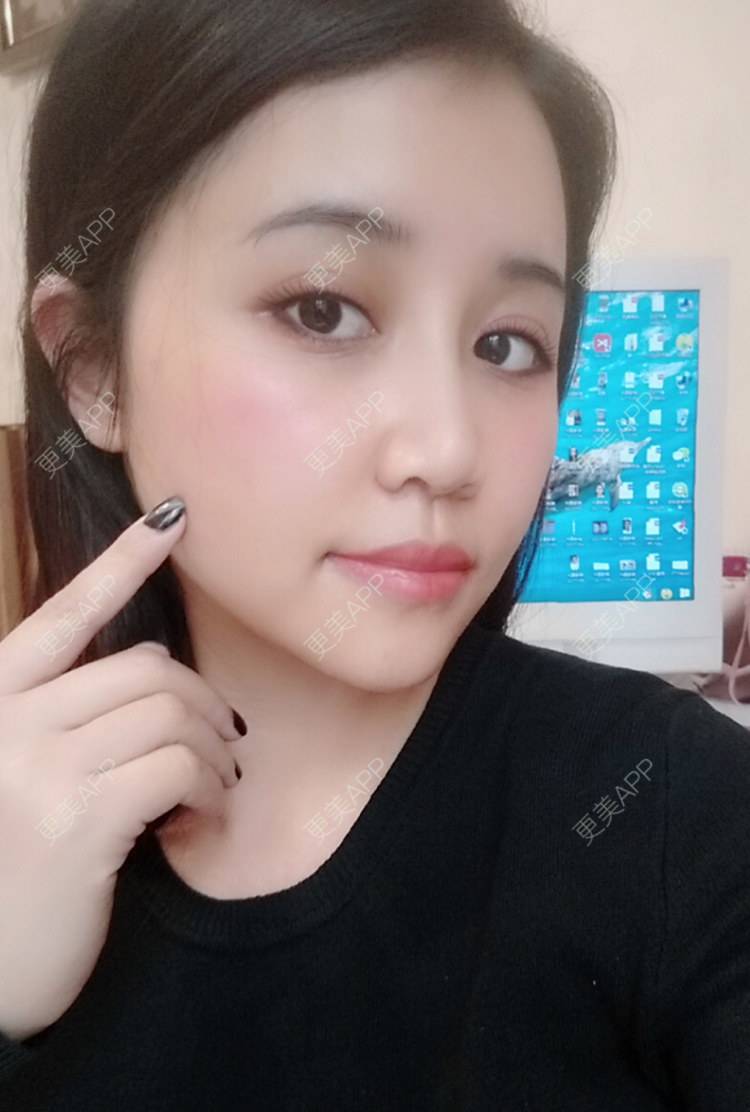 更美 - 更美用户or8Y3L3Y08的经验 | 自体脂肪面部年轻化 | 自体脂肪丰太阳穴 | 自体脂肪面部填充