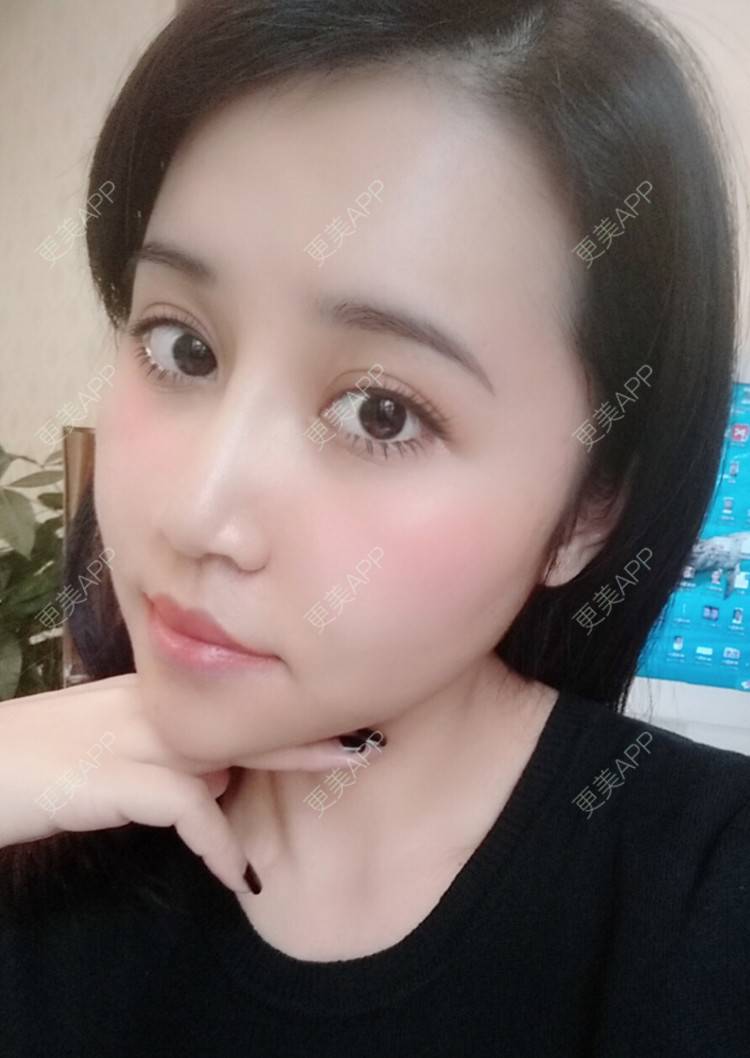 更美 - 更美用户or8Y3L3Y08的经验 | 自体脂肪面部年轻化 | 自体脂肪丰太阳穴 | 自体脂肪面部填充