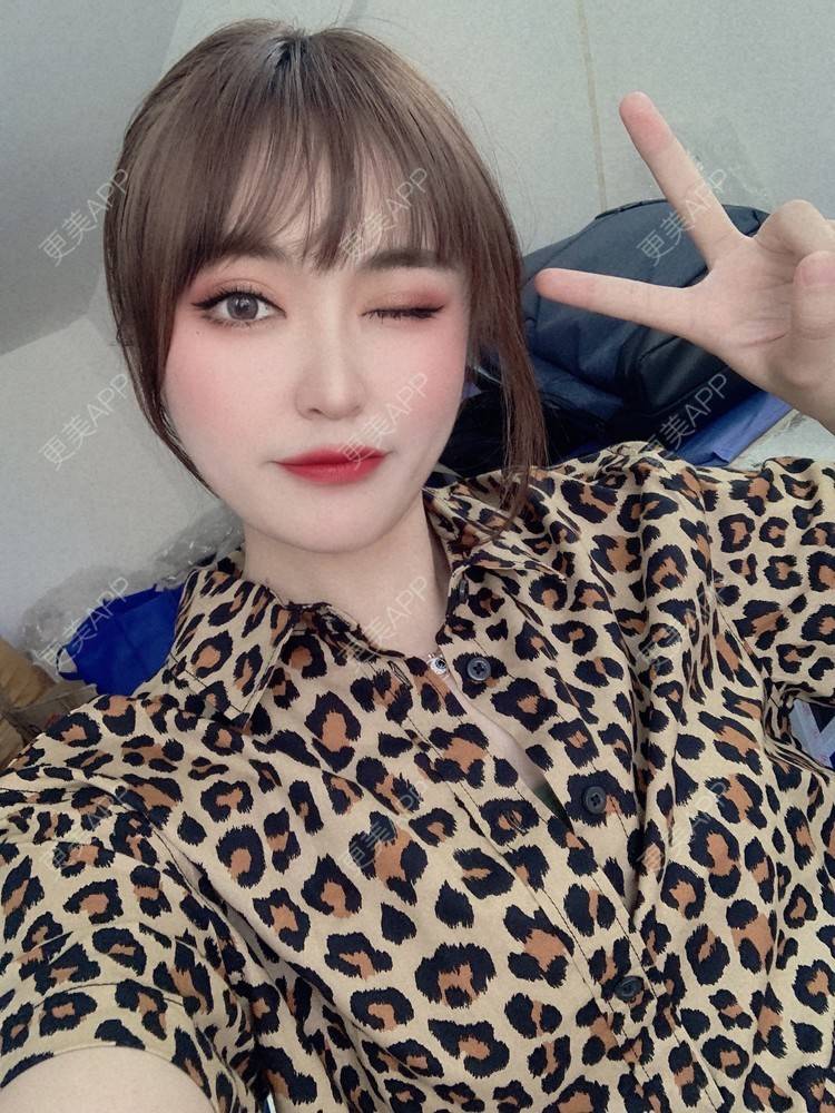 更美 - 寻欢客乃的全切双眼皮经验 | 视频日记 | 全切双眼皮 | 天津