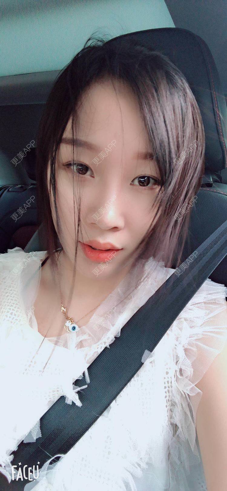 更美 - 小玉米要乖乖的肋软骨隆鼻经验 | 北京 | 肋软骨隆鼻