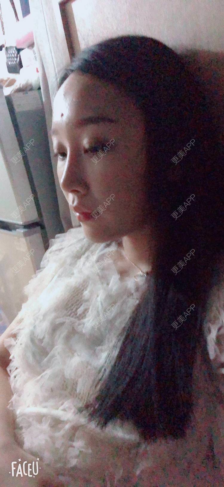 更美 - 小玉米要乖乖的肋软骨隆鼻经验 | 北京 | 肋软骨隆鼻