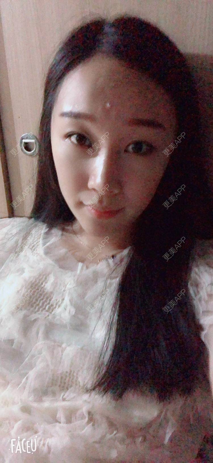 更美 - 小玉米要乖乖的肋软骨隆鼻经验 | 北京 | 肋软骨隆鼻
