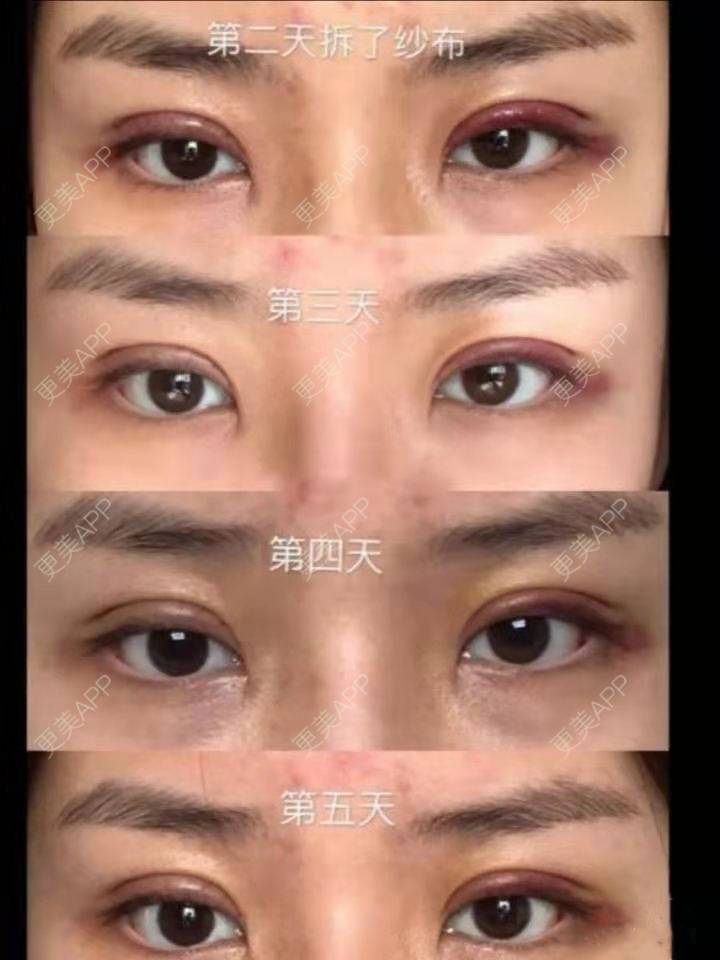 更美 - THe贤寳的双眼皮经验 | 双眼皮 | 双眼皮修复 | 临沂