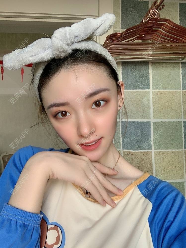 更美 - 更美用户fr8nl5Ywgd的颧弓降低经验 | 郑州 | 颧弓降低