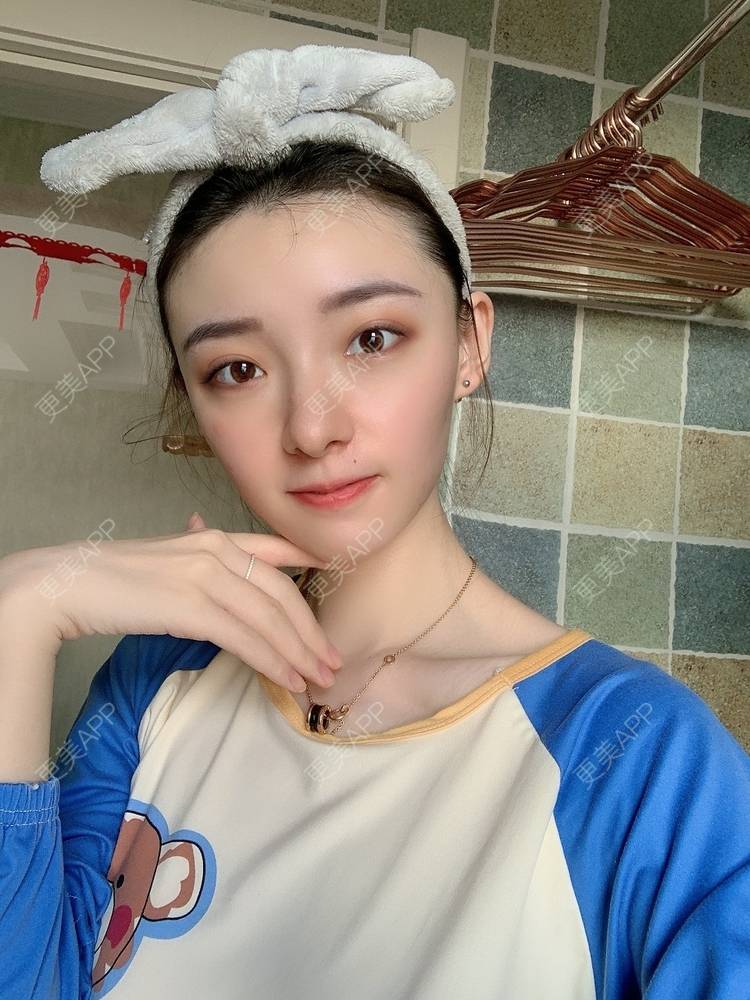 更美 - 更美用户fr8nl5Ywgd的颧弓降低经验 | 郑州 | 颧弓降低