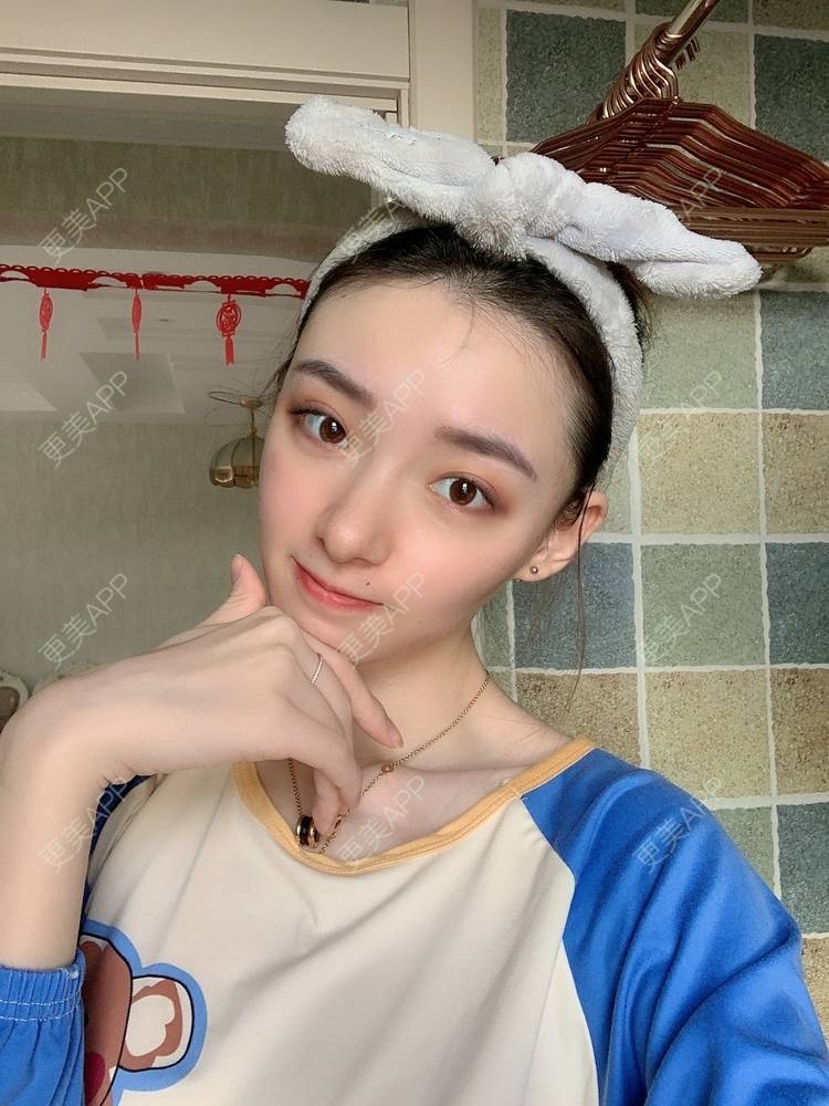 更美 - 更美用户fr8nl5Ywgd的颧弓降低经验 | 郑州 | 颧弓降低
