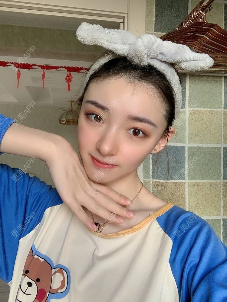 更美 - 更美用户fr8nl5Ywgd的颧弓降低经验 | 郑州 | 颧弓降低