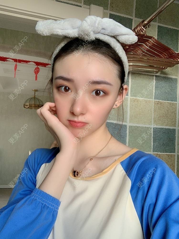 更美 - 更美用户fr8nl5Ywgd的颧弓降低经验 | 郑州 | 颧弓降低