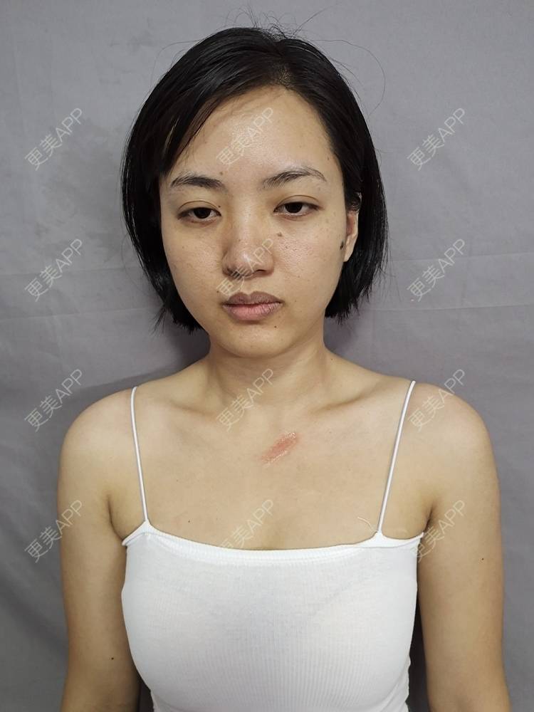 更美 - 帅到灵魂深处蔷的激光淡疤经验 | 综合淡疤 | 皮肤美容 | 激光淡疤 | 成都