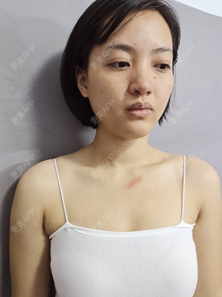 更美 - 帅到灵魂深处蔷的激光淡疤经验 | 综合淡疤 | 皮肤美容 | 激光淡疤 | 成都