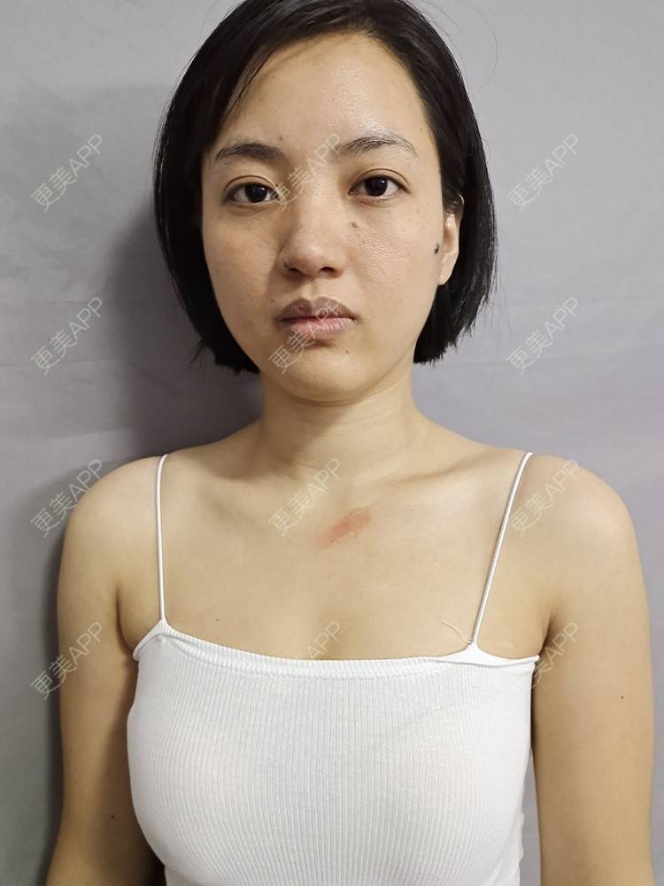 更美 - 帅到灵魂深处蔷的激光淡疤经验 | 综合淡疤 | 皮肤美容 | 激光淡疤 | 成都