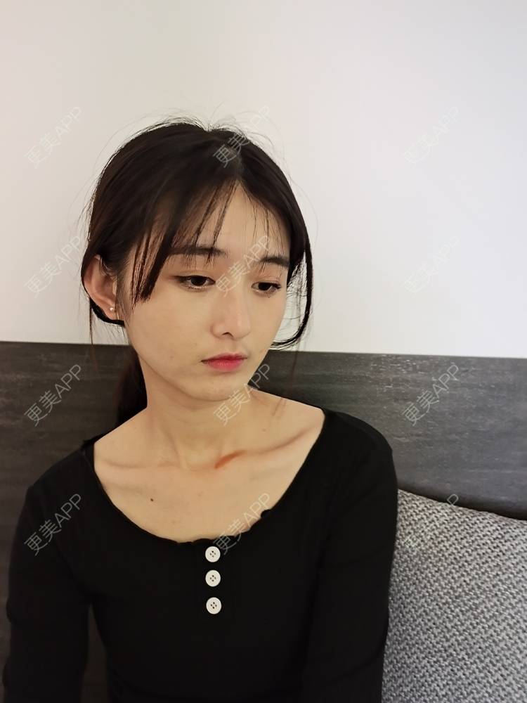 更美 - 更美用户Nk6w933b9g的激光淡疤经验 | 皮肤综合管理套餐 | 皮肤美容 | 激光淡疤 | 成都